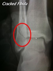 Cracked_fibula
